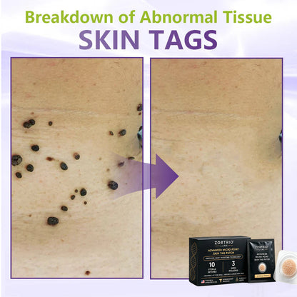 TAG IT. GONE. ZORTRIO LABS Advanced Micro-Point Skin Tag Patch 10 Sterile Patches · 3 Sizes Included