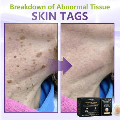 TAG IT. GONE. ZORTRIO LABS Advanced Micro-Point Skin Tag Patch 10 Sterile Patches · 3 Sizes Included