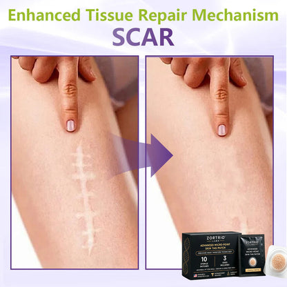 TAG IT. GONE. ZORTRIO LABS Advanced Micro-Point Skin Tag Patch 10 Sterile Patches · 3 Sizes Included